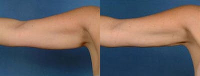 Liposuction for Women Before & After Gallery - Patient 296141 - Image 1