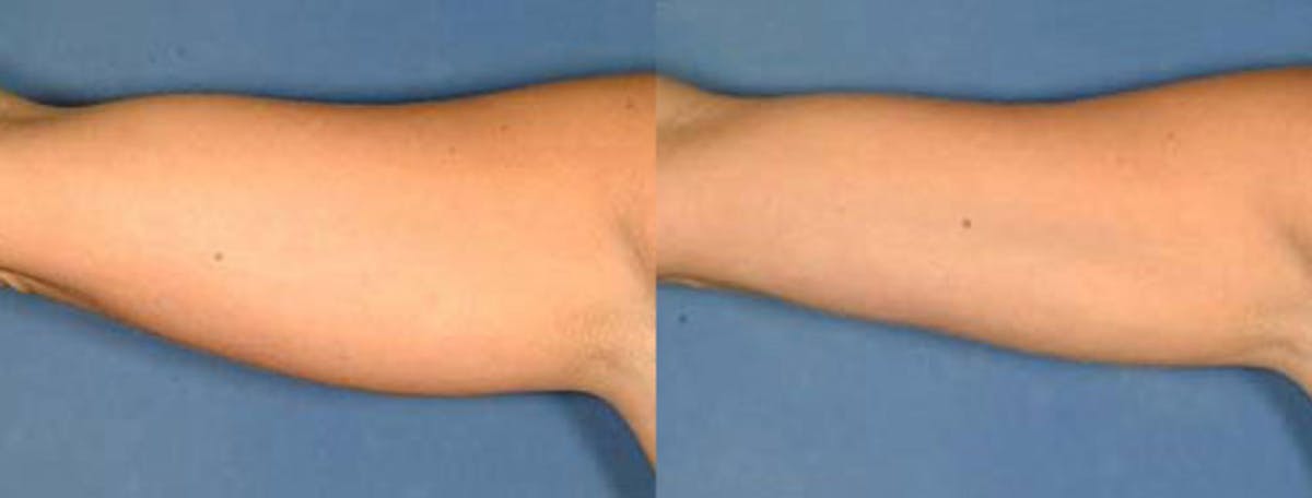 Liposuction for Women Before & After Gallery - Patient 413373 - Image 1