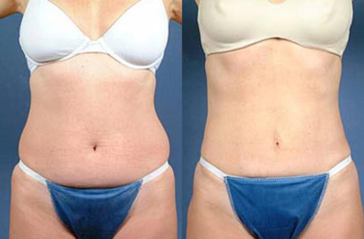 Liposuction for Women Before & After Gallery - Patient 339494 - Image 1