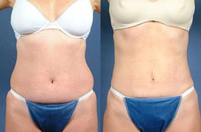 Liposuction for Women Before & After Gallery - Patient 339494 - Image 1