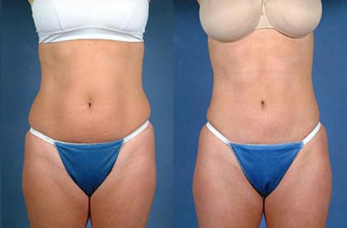 Liposuction for Women Before & After Gallery - Patient 188027 - Image 1
