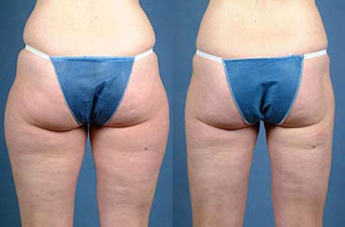 Liposuction for Women Before & After Gallery - Patient 166155 - Image 2