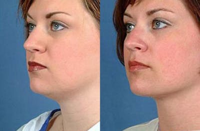 Neck Procedures Before & After Gallery - Patient 375359 - Image 1