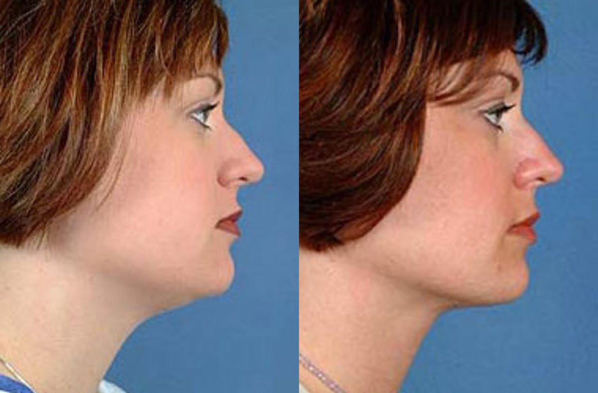 Neck Procedures Before & After Gallery - Patient 375359 - Image 2