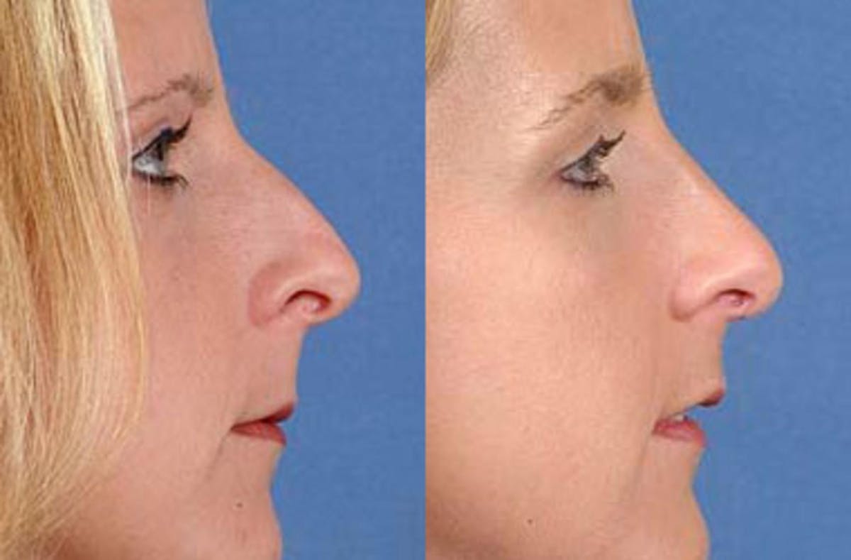 Nose Reshaping Before & After Gallery - Patient 211716 - Image 2