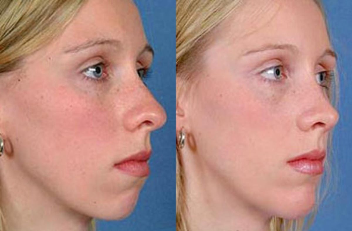 Nose Reshaping Before & After Gallery - Patient 348077 - Image 2