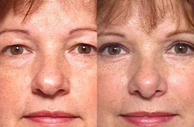 Nose Reshaping Before & After Gallery - Patient 539894 - Image 1