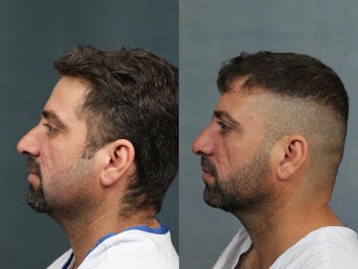 Rhinoplasty Before & After Gallery - Patient 164086 - Image 1