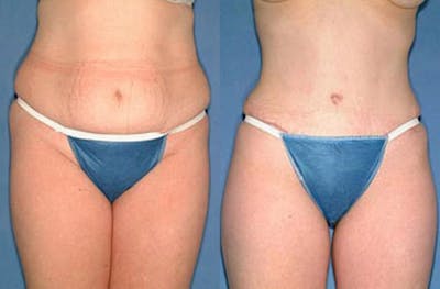 Tummy Tuck Before & After Gallery - Patient 302569 - Image 1