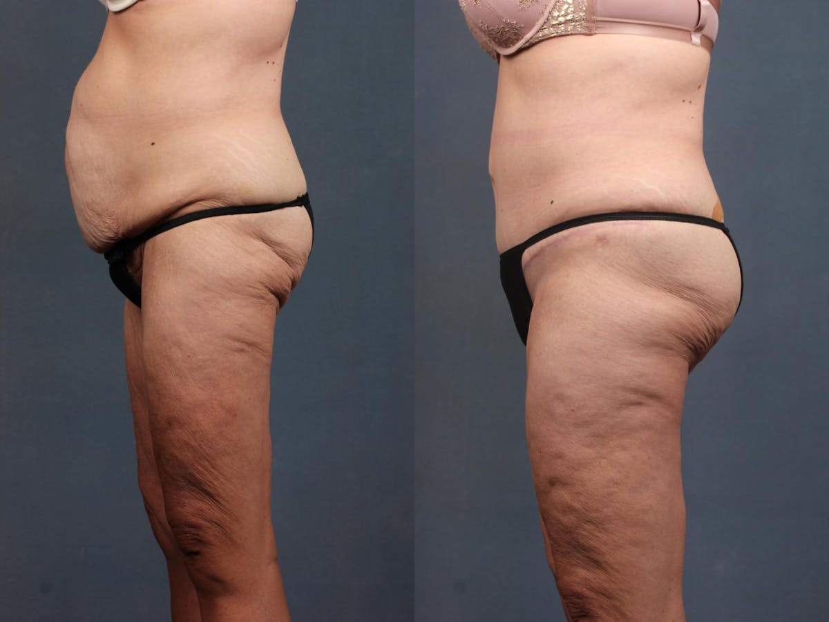 Tummy Tuck Before & After Gallery - Patient 298245 - Image 2