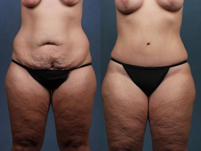Tummy Tuck Before & After Gallery - Patient 234930 - Image 1