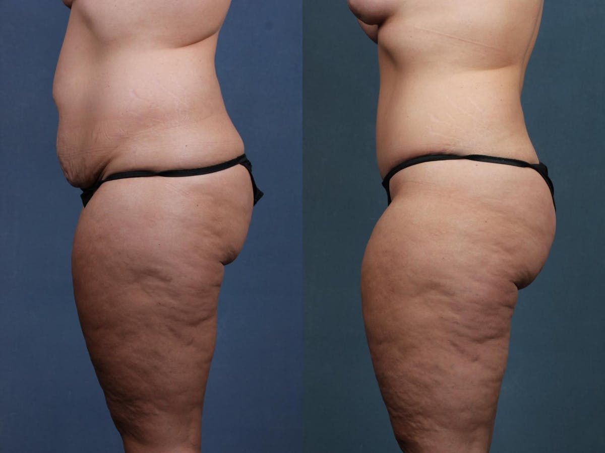 Tummy Tuck Before & After Gallery - Patient 234930 - Image 2