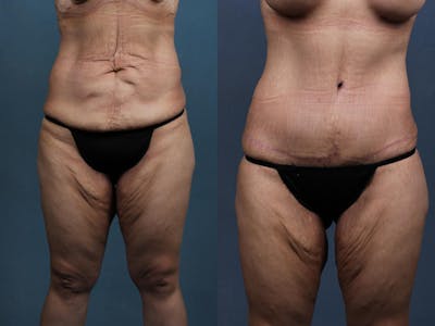 Tummy Tuck Before & After Gallery - Patient 211182 - Image 1