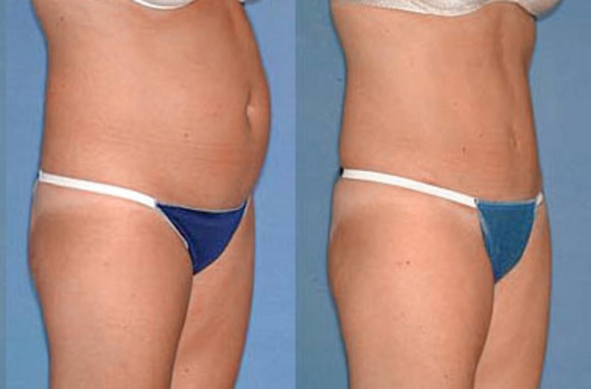 Tummy Tuck Before & After Gallery - Patient 412708 - Image 2