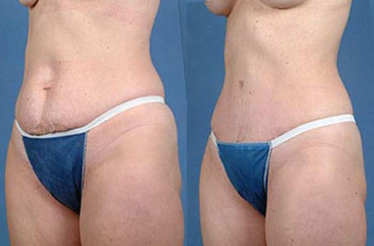Tummy Tuck Before & After Gallery - Patient 589496 - Image 2