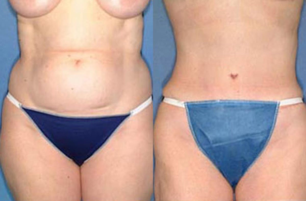 Tummy Tuck Before & After Gallery - Patient 998048 - Image 1