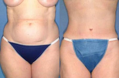 Tummy Tuck Before & After Gallery - Patient 998048 - Image 1