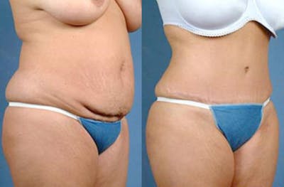 Tummy Tuck Before & After Gallery - Patient 377312 - Image 1