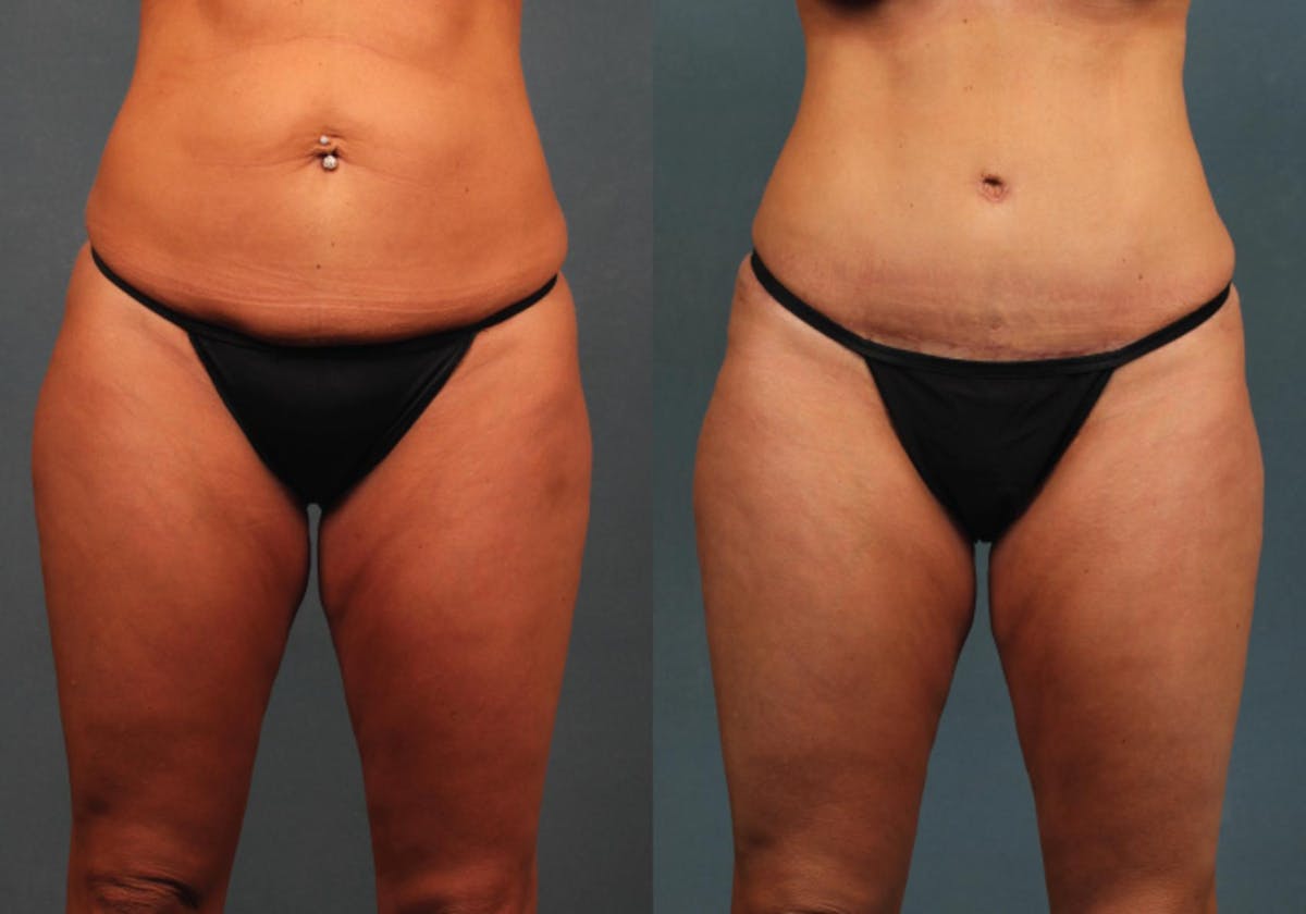Tummy Tuck Before & After Gallery - Patient 118149 - Image 1