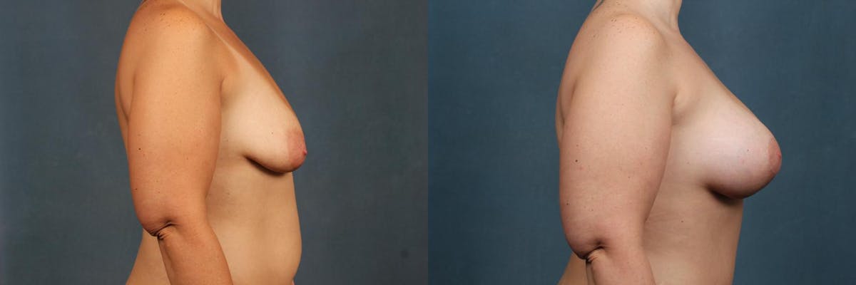 Lift Before & After Gallery - Patient 319088 - Image 3