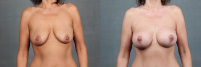 Mommy Makeover Before & After Gallery - Patient 404767 - Image 1