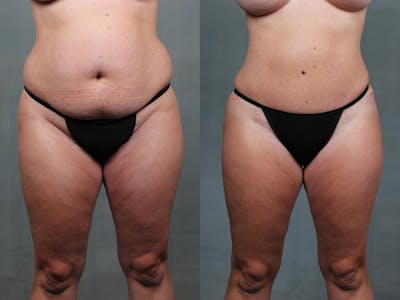 Mommy Makeover Before & After Gallery - Patient 205143 - Image 1