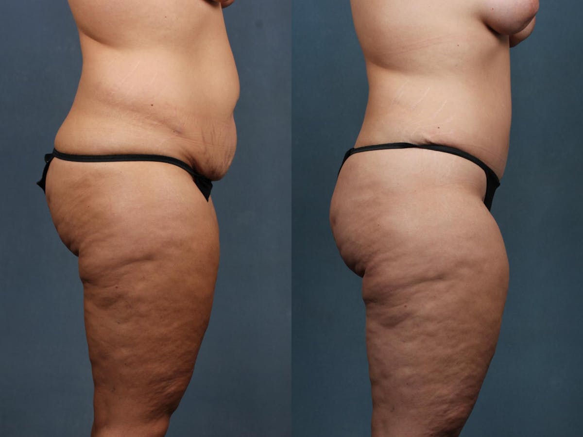 Mommy Makeover Before & After Gallery - Patient 209096 - Image 3