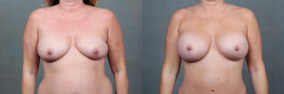 Mommy Makeover Before & After Gallery - Patient 864406 - Image 1