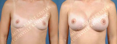 Enlargement - Saline Before & After Gallery - Patient 309539 - Image 1