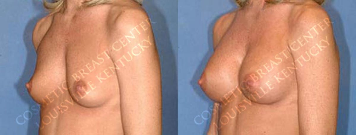 Enlargement - Saline Before & After Gallery - Patient 333663 - Image 2