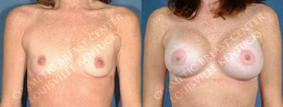 Enlargement - Saline Before & After Gallery - Patient 165419 - Image 1