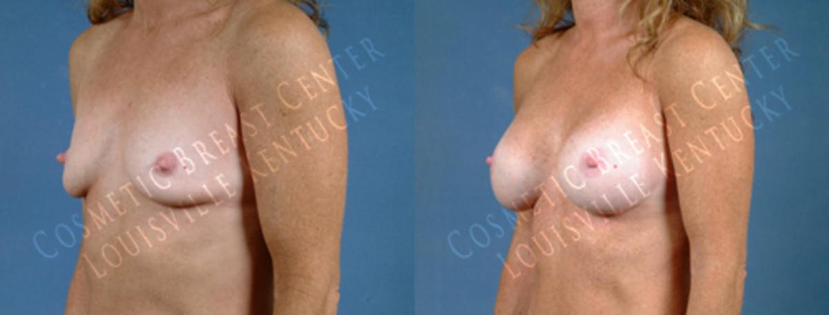 Enlargement - Saline Before & After Gallery - Patient 158864 - Image 2