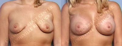 Enlargement - Saline Before & After Gallery - Patient 254546 - Image 1