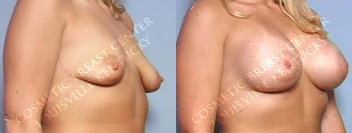 Enlargement - Saline Before & After Gallery - Patient 254546 - Image 2