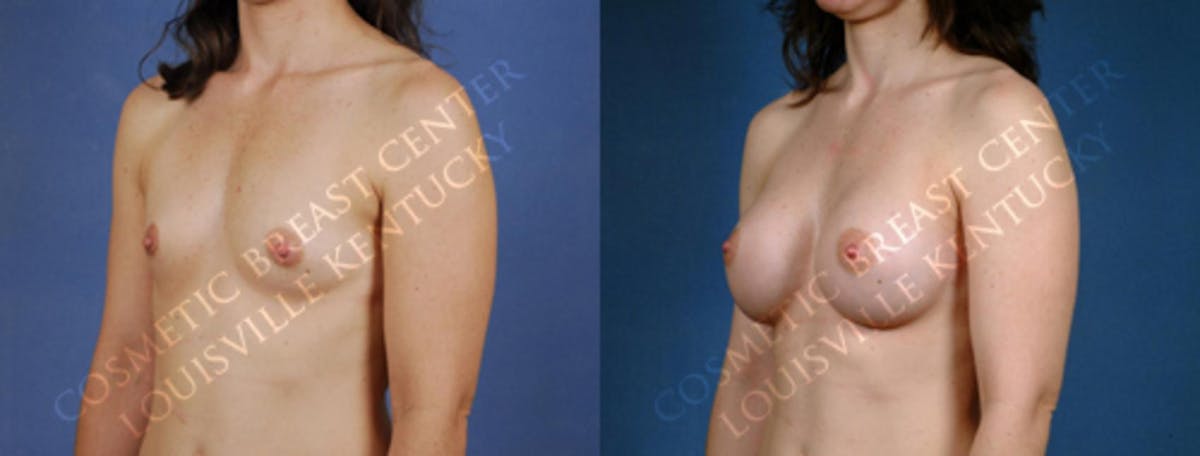 Enlargement - Saline Before & After Gallery - Patient 119983 - Image 2