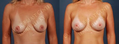 Enlargement - Saline Before & After Gallery - Patient 417385 - Image 1