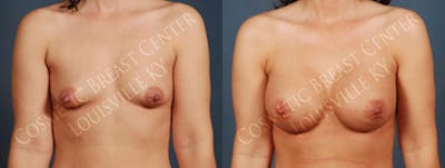 Enlargement - Saline Before & After Gallery - Patient 890938 - Image 1