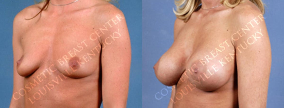 Enlargement - Saline Before & After Gallery - Patient 214149 - Image 2