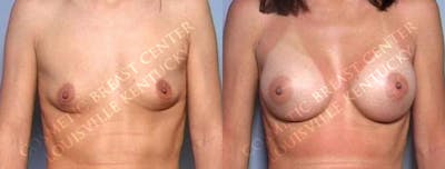 Enlargement - Saline Before & After Gallery - Patient 119472 - Image 1