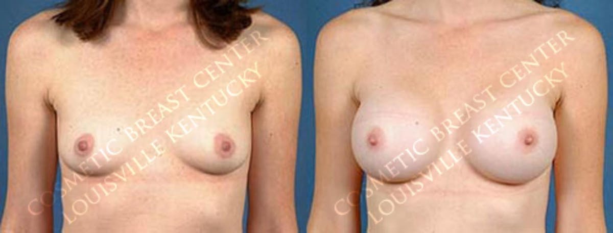 Enlargement - Saline Before & After Gallery - Patient 427431 - Image 1