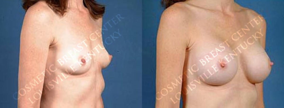 Enlargement - Saline Before & After Gallery - Patient 427431 - Image 2