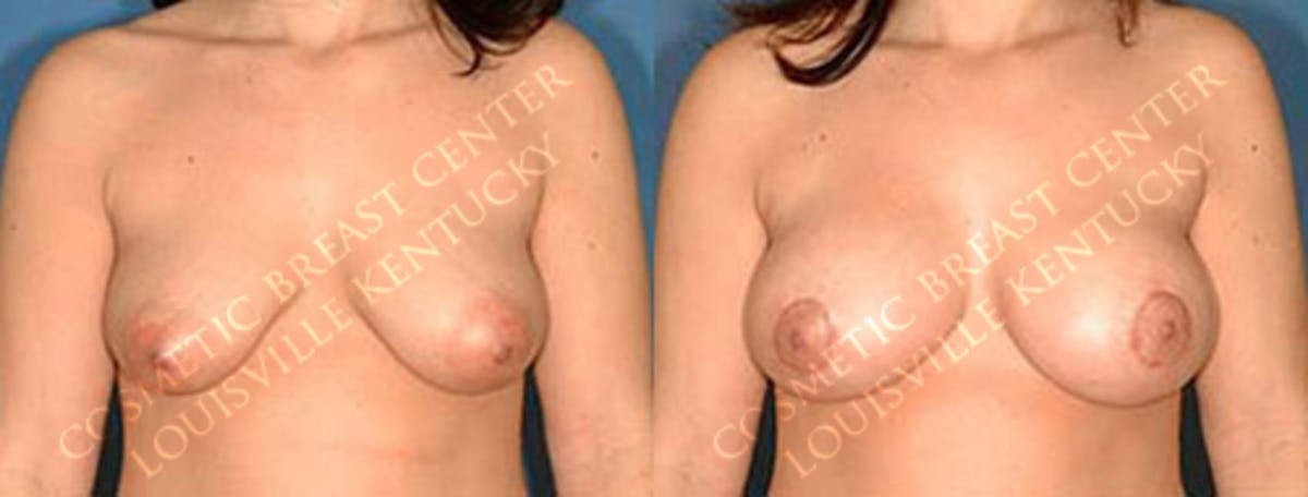 Enlargement - Saline Before & After Gallery - Patient 816772 - Image 1