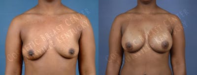Enlargement - Saline Before & After Gallery - Patient 393306 - Image 1