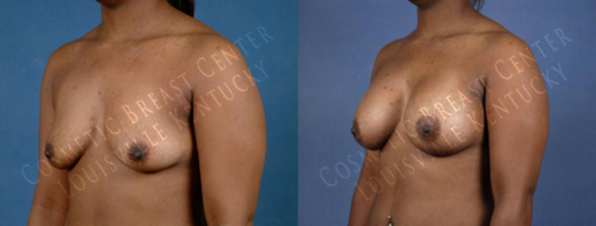 Enlargement - Saline Before & After Gallery - Patient 393306 - Image 2