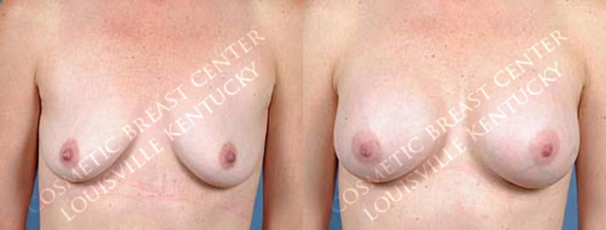 Enlargement - Saline Before & After Gallery - Patient 336758 - Image 1