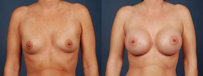 Enlargement - Saline Before & After Gallery - Patient 417579 - Image 1