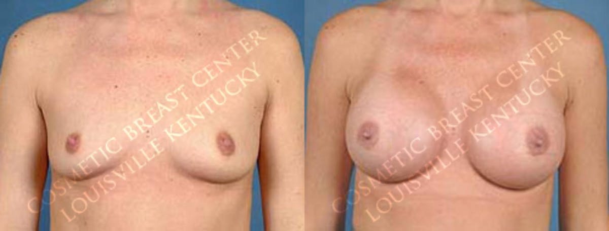 Enlargement - Saline Before & After Gallery - Patient 297018 - Image 1