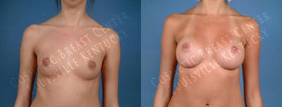 Enlargement - Saline Before & After Gallery - Patient 260734 - Image 1