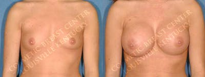 Enlargement - Saline Before & After Gallery - Patient 349872 - Image 1