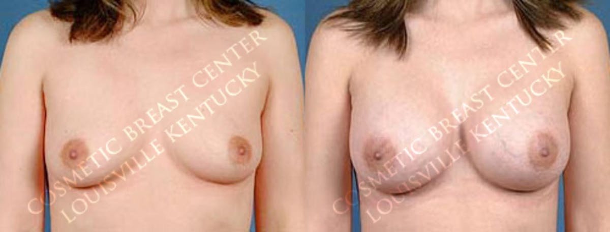 Enlargement - Saline Before & After Gallery - Patient 210936 - Image 1